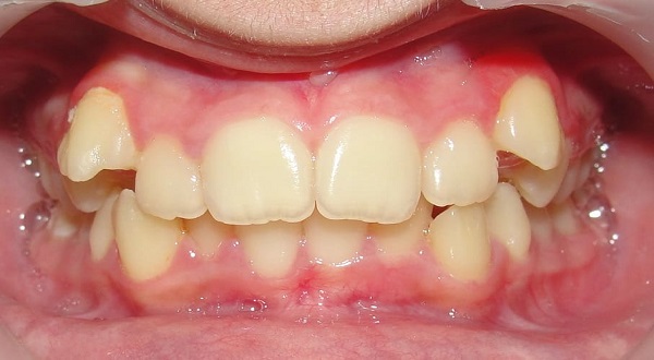 أهم (4) أسباب لازدحام الاسنان، وطرق علاجه