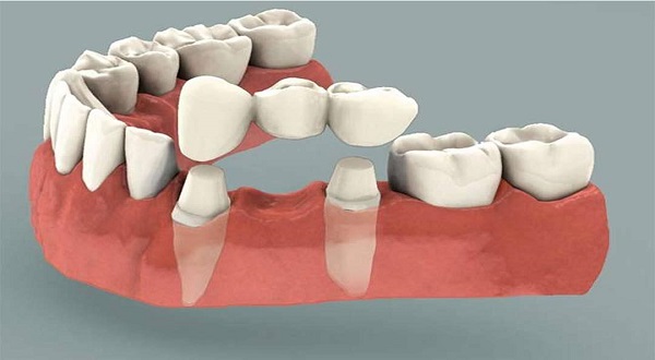 ما هي أفضل أنواع جسر الاسنان وكيف يمكن الاختيار بينها؟