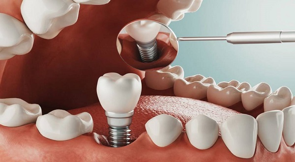 أهم (3) بدائل زراعة الاسنان، وكيفية الحفاظ عليها