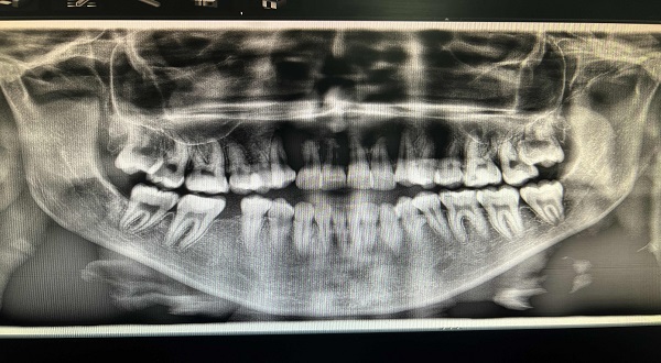 ما هي انواع اشعة الاسنان؟ ومتى نستخدم كل نوع - Basmati Clinics