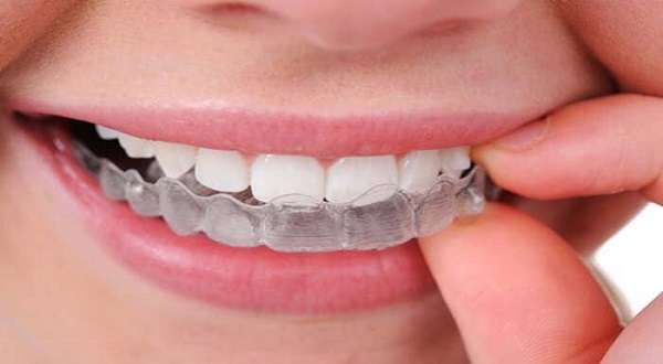 (7) من أهم ميزات تقويم الاسنان المتحرك