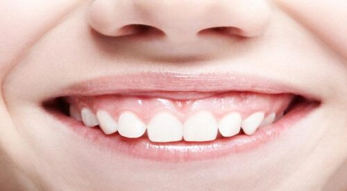 علاج الابتسامة اللثوية