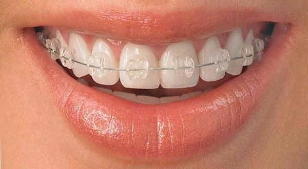 (4) من مزايا تقويم الاسنان الشفاف(Invisalign)