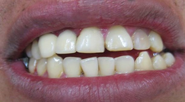 التبييض الداخلي للسن