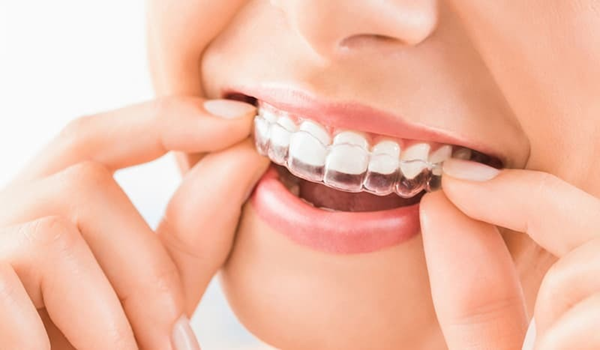 (5) من اهم مميزات قوالب تبييض الاسنان